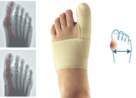 "epitact" Korrekturorthese Hallux-Valgus