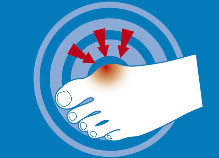 epitact Epithelium 26® Hallux valgus-Schutz HAUT