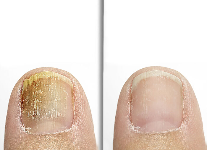 Anti-Fuß- und Nagelpilzspray 